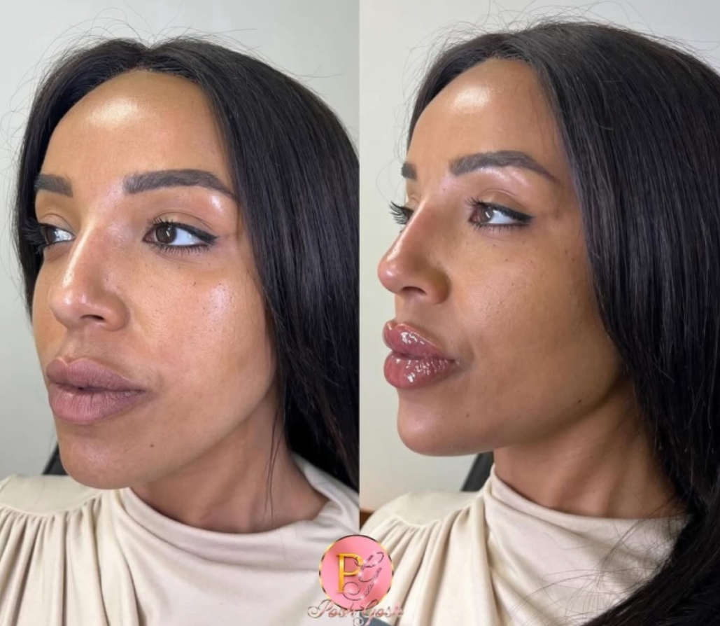 Posh Gosh 360° harmonization before and after — natural lip and facial balancing