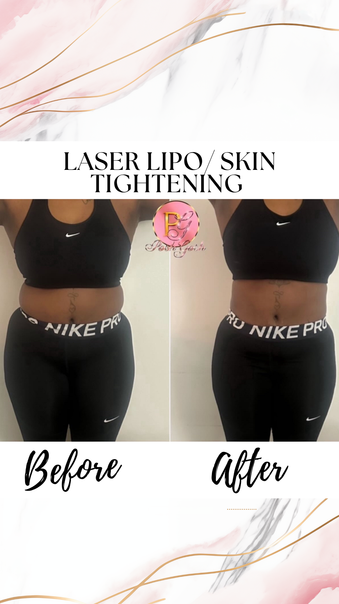 Posh Gosh laser lipo before and after — Waist & Core Sculpt