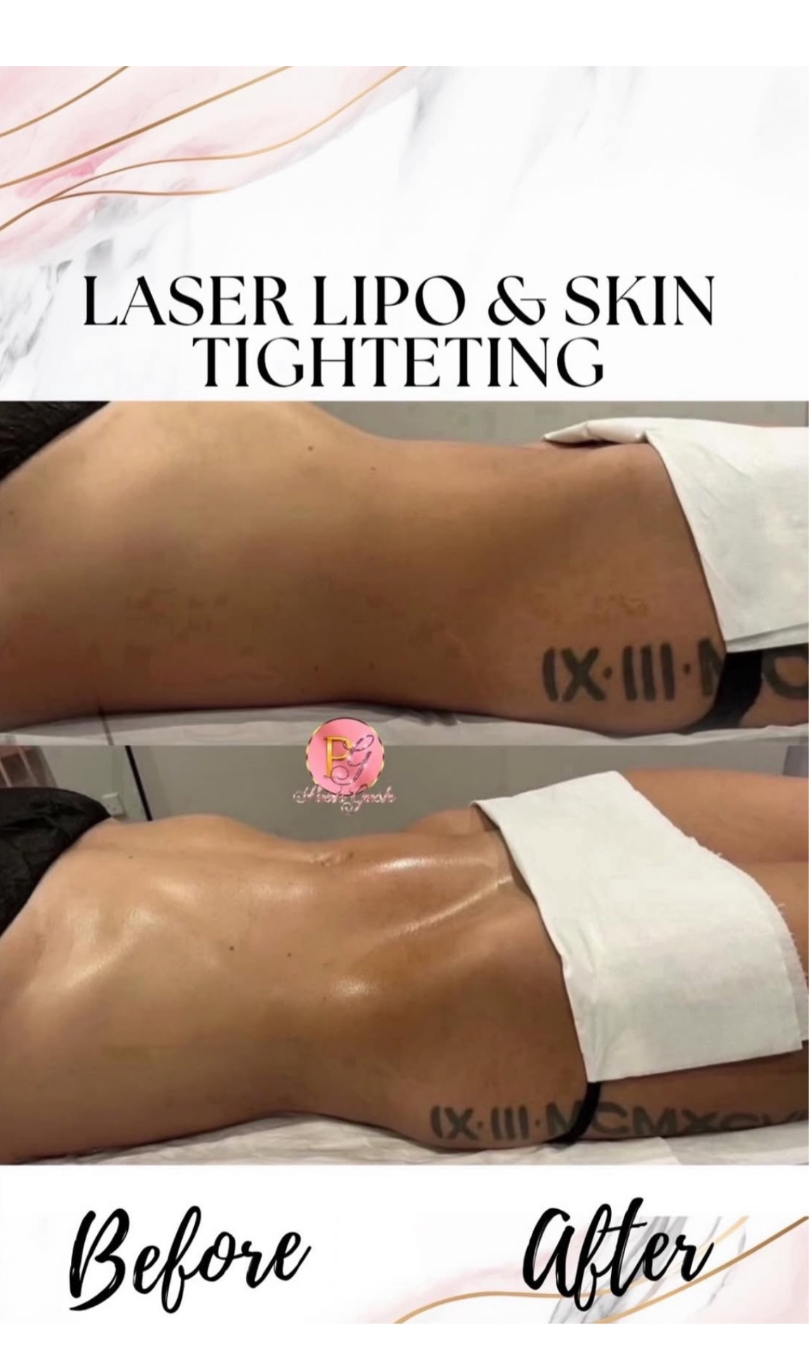 Posh Gosh laser lipo before and after — Back & Bra-Line Smooth