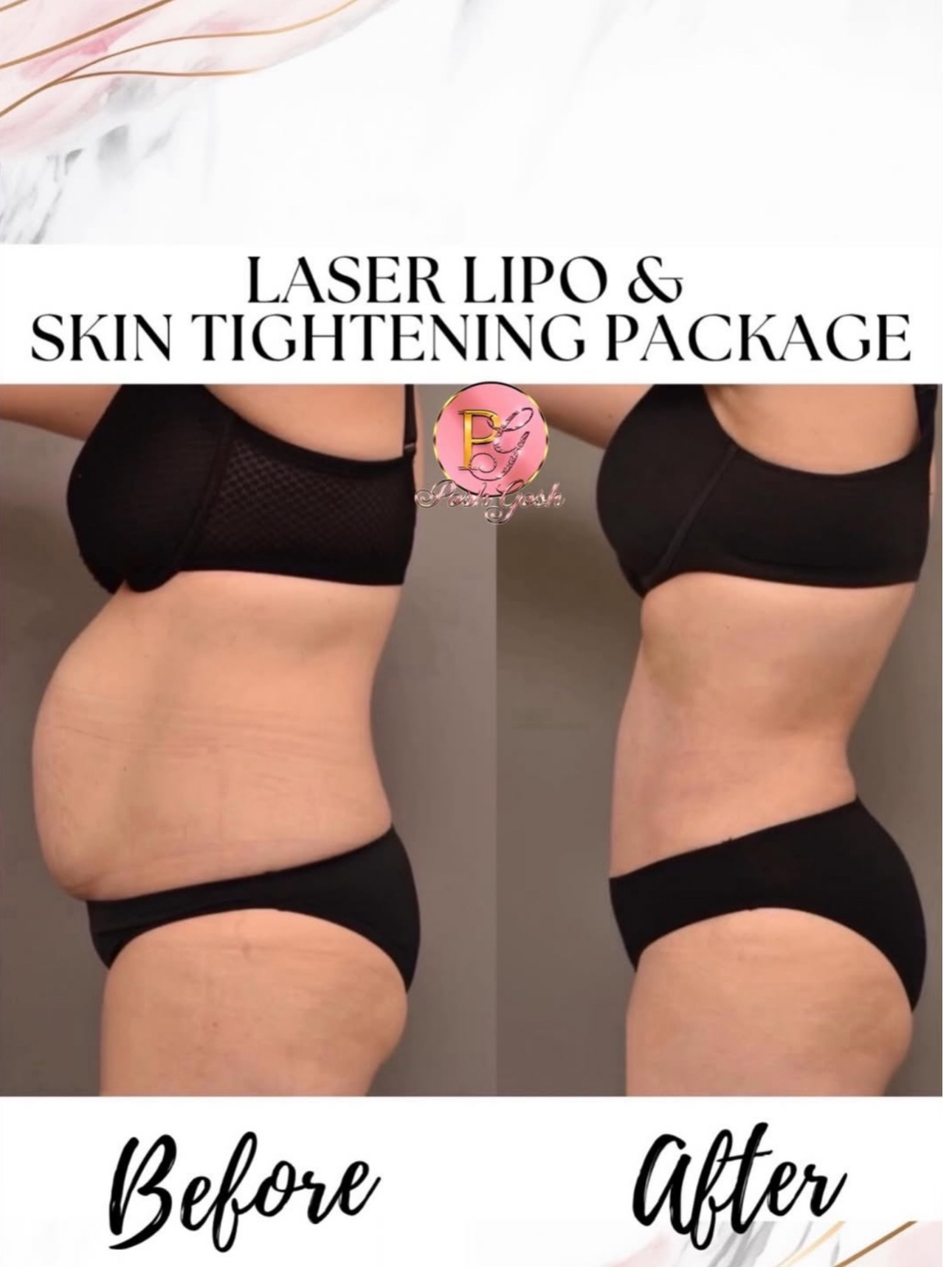 Posh Gosh laser lipo before and after — Abdomen Contour