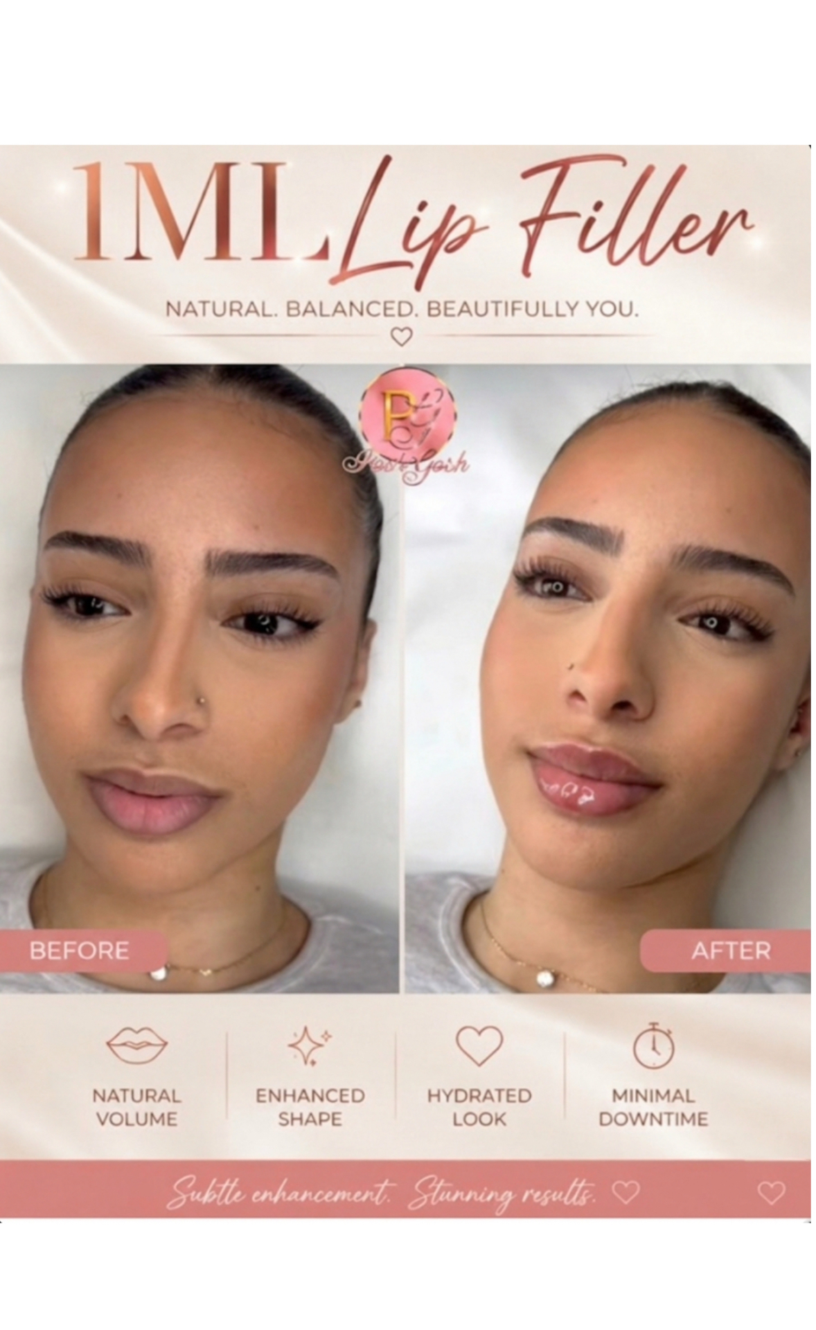 Posh Gosh lip filler before and after — Natural Volume · Single Session